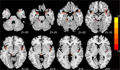 Dynamic changes in fractional amplitude of low-frequency fluctuations in patients with chronic insomnia